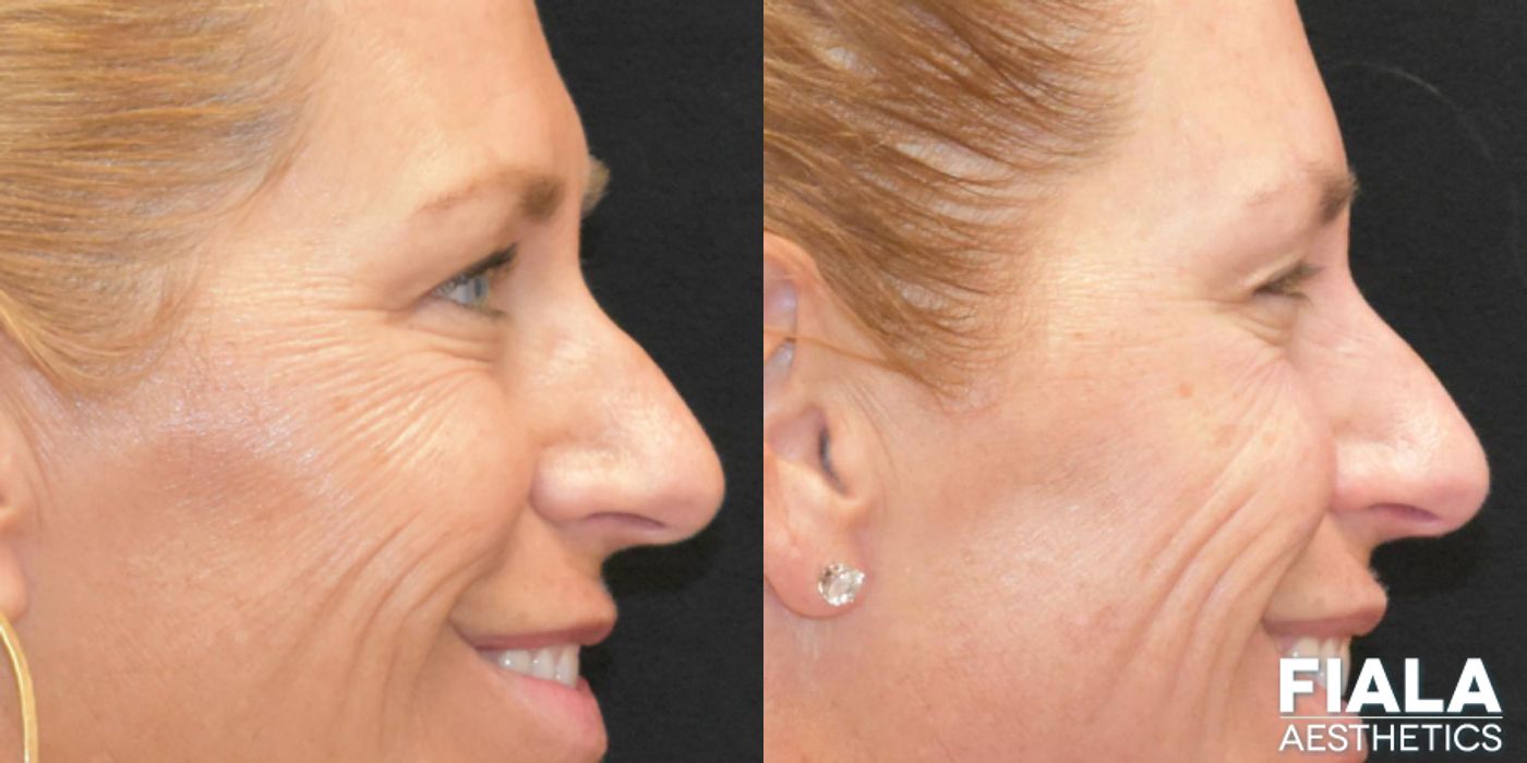 BOTOX Cosmetic - Thumbnail 4