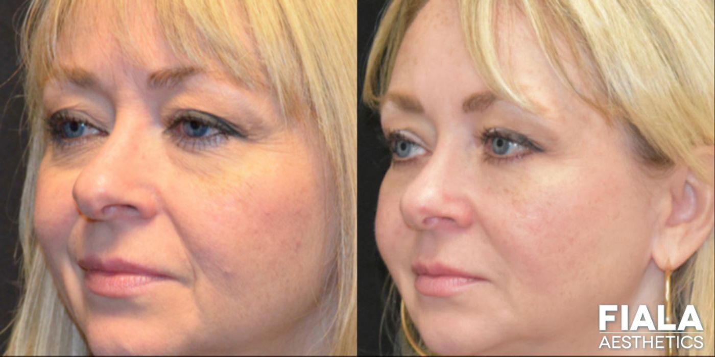 Before and after BOTOX Cosmetic case 13944 - Angle 6