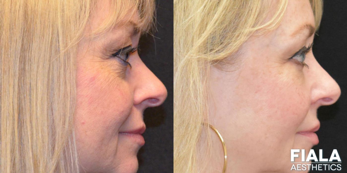 BOTOX Cosmetic - Thumbnail 5