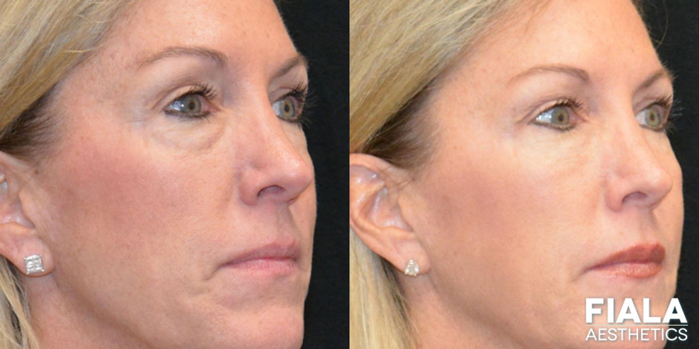 Before and after Dermal Fillers case 13916 - Angle 5
