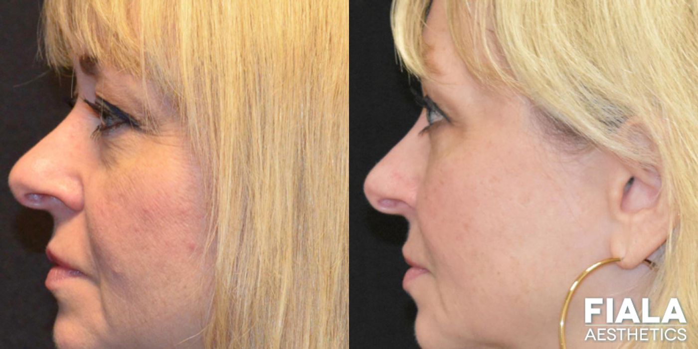 Before and after BOTOX Cosmetic case 13944 - Angle 8