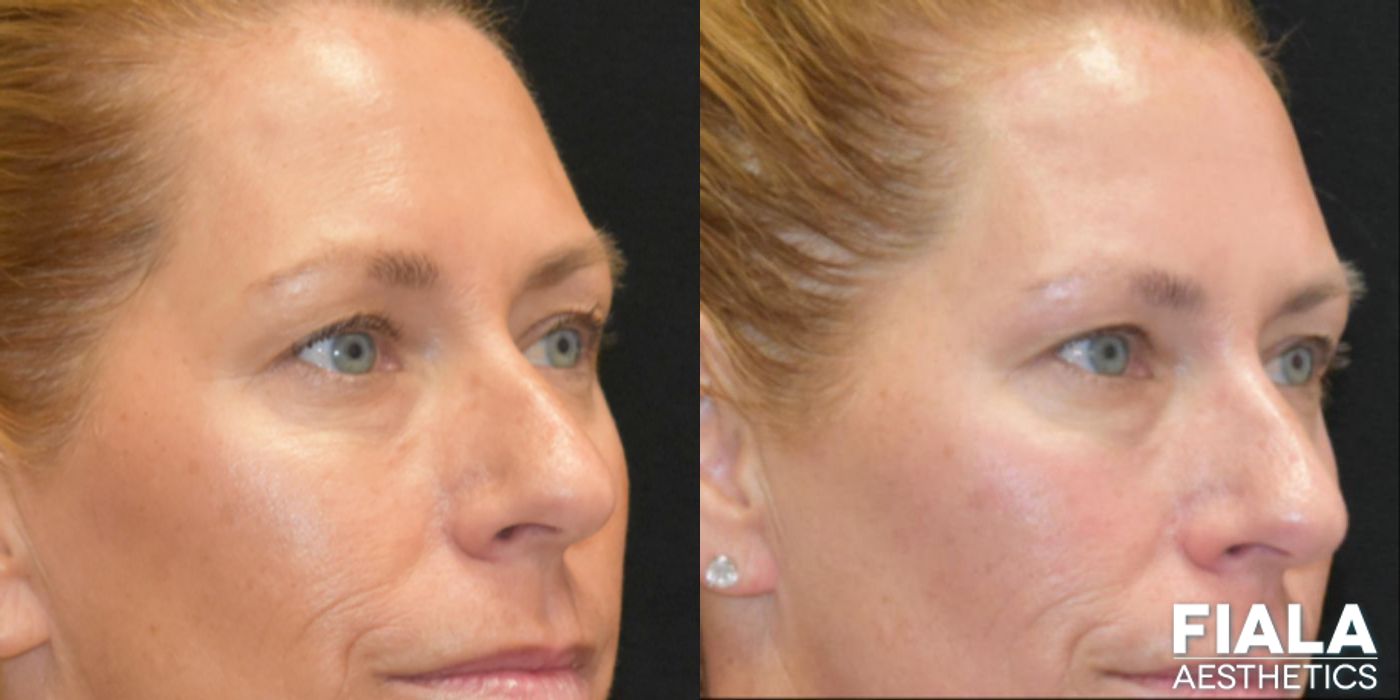 BOTOX Cosmetic - Thumbnail 5