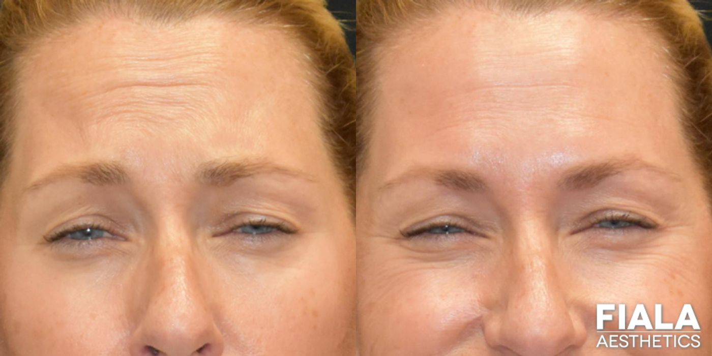 Before and after BOTOX Cosmetic case 13914 - Angle 3