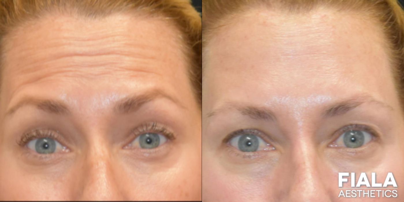 Before and after BOTOX Cosmetic case 13914