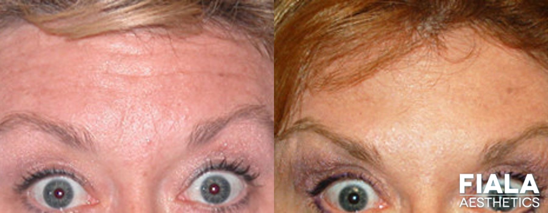 Before and after BOTOX Cosmetic case 13913