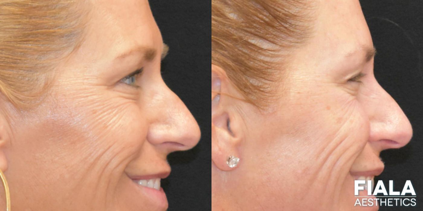 Before and after BOTOX Cosmetic case 13914 - Angle 5