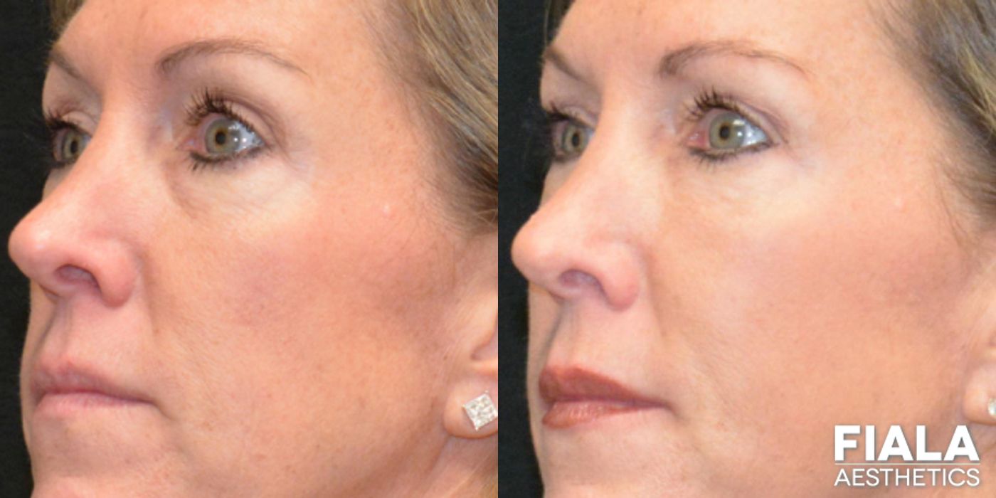 Before and after Dermal Fillers case 13916 - Angle 7
