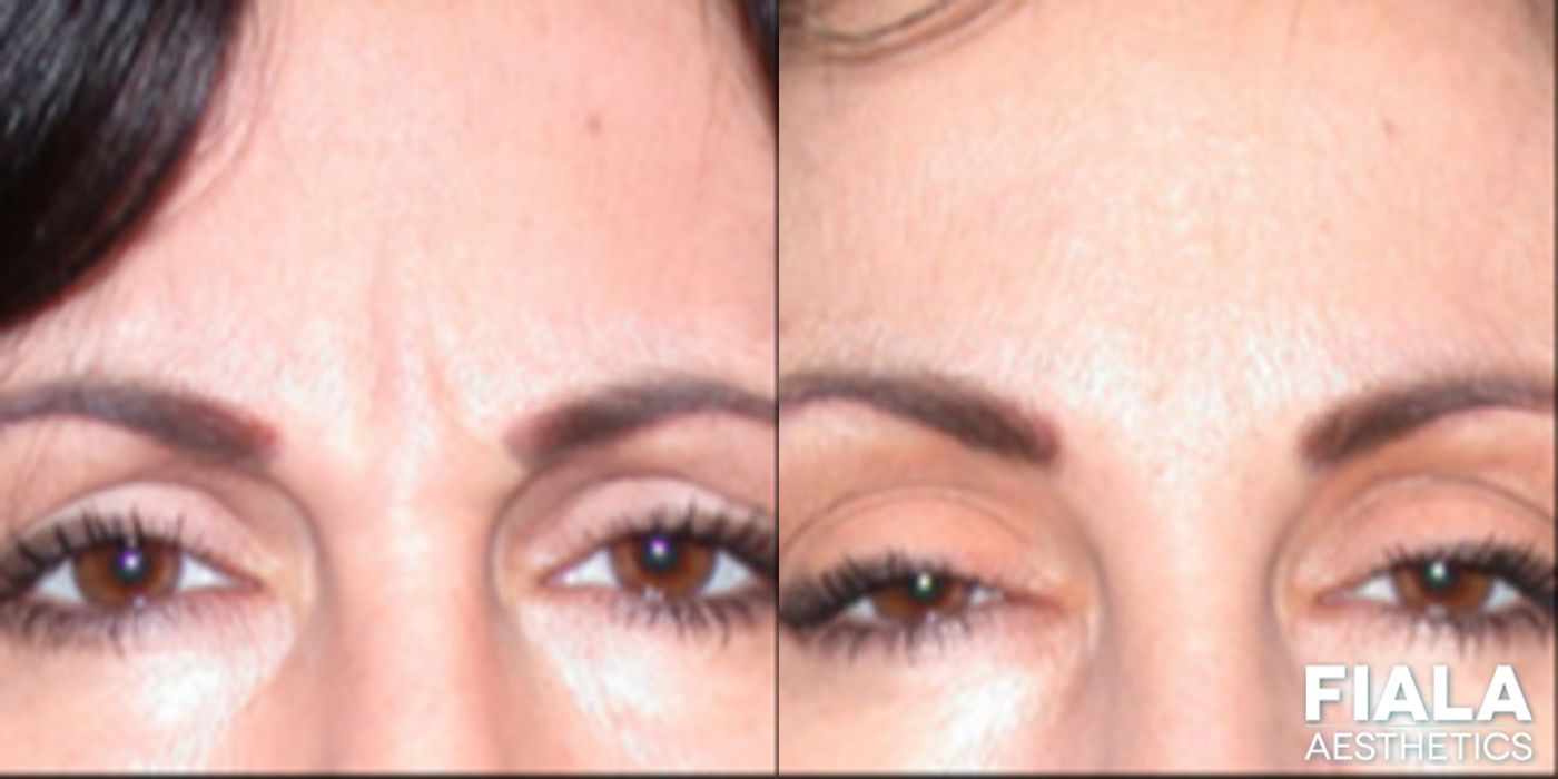 Before and after BOTOX Cosmetic case 13908