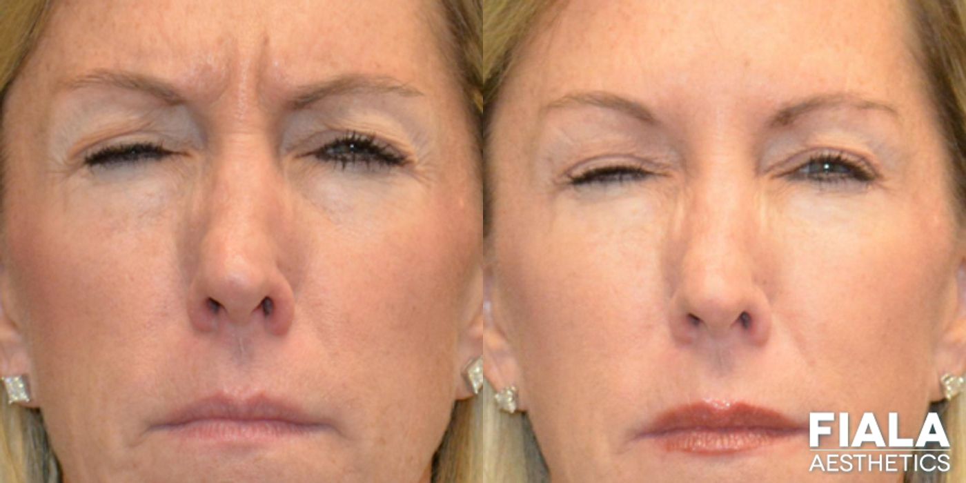Before and after Dermal Fillers case 13916 - Angle 2