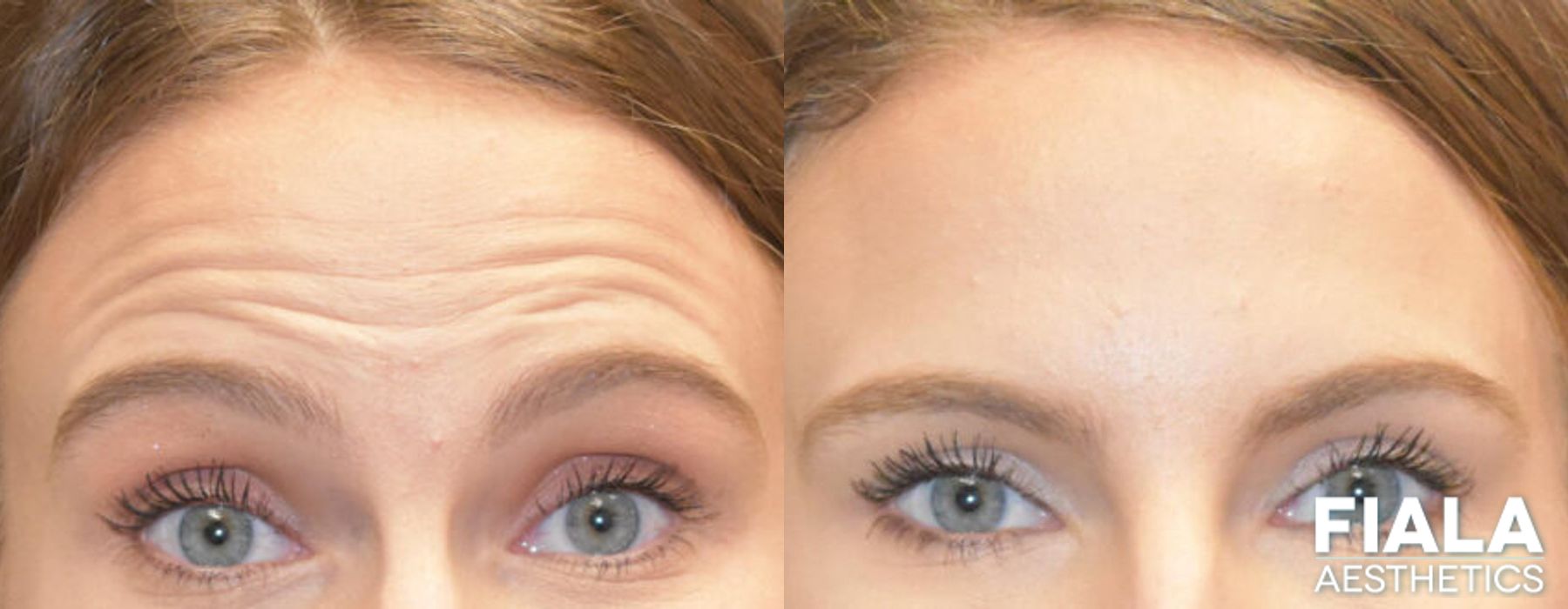 Botox results showing softened glabellar lines and forehead wrinkles with smoother, refreshed appearance by Dr. Fiala in Orlando