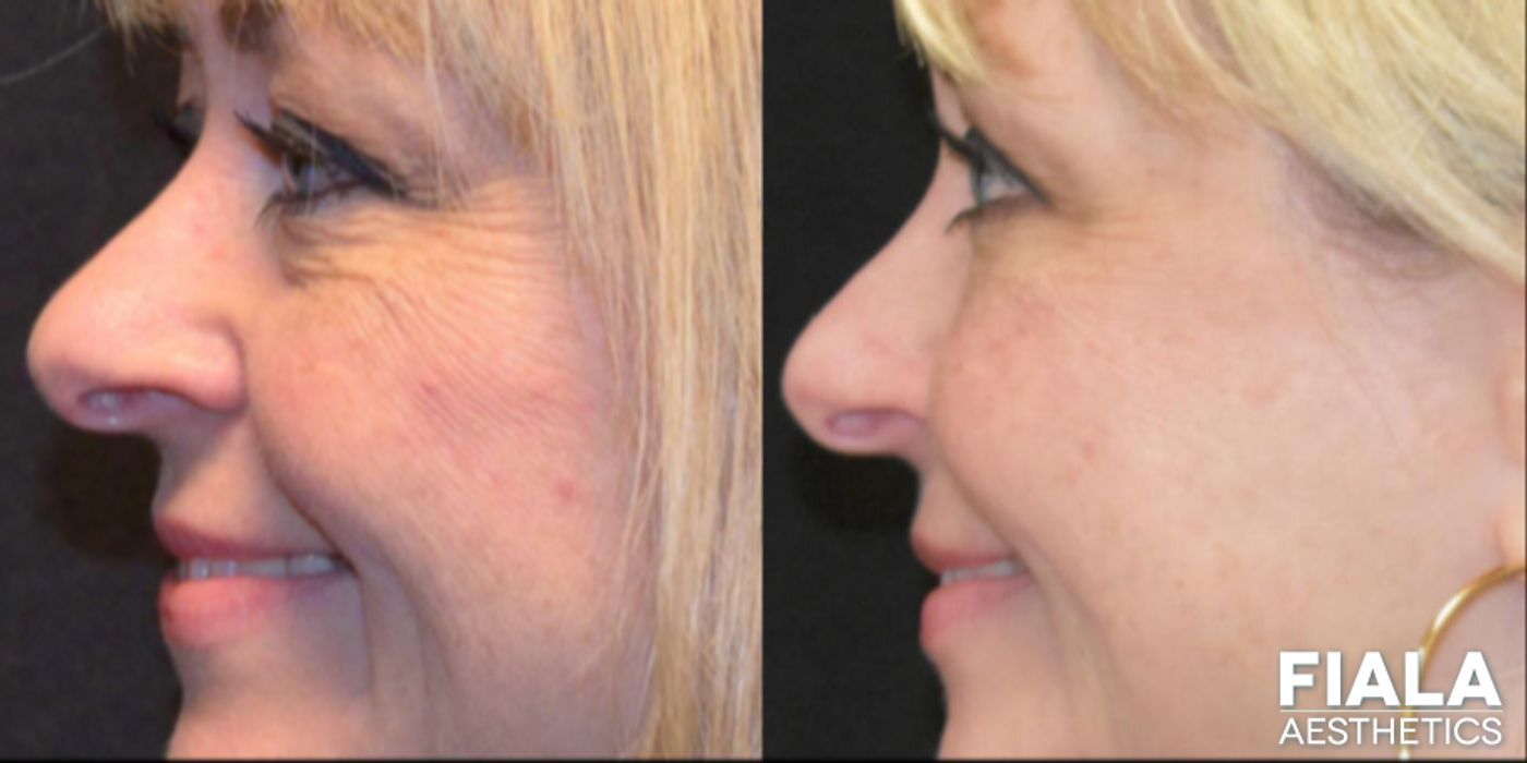 Before and after BOTOX Cosmetic case 13944 - Angle 7