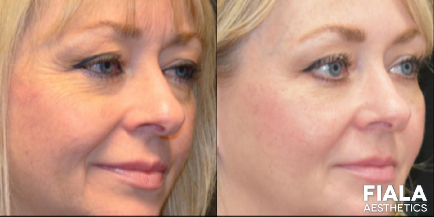 Before and after BOTOX Cosmetic case 13944 - Angle 3