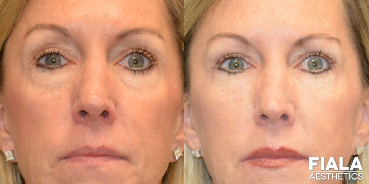 Before and after Dermal Fillers case 13916
