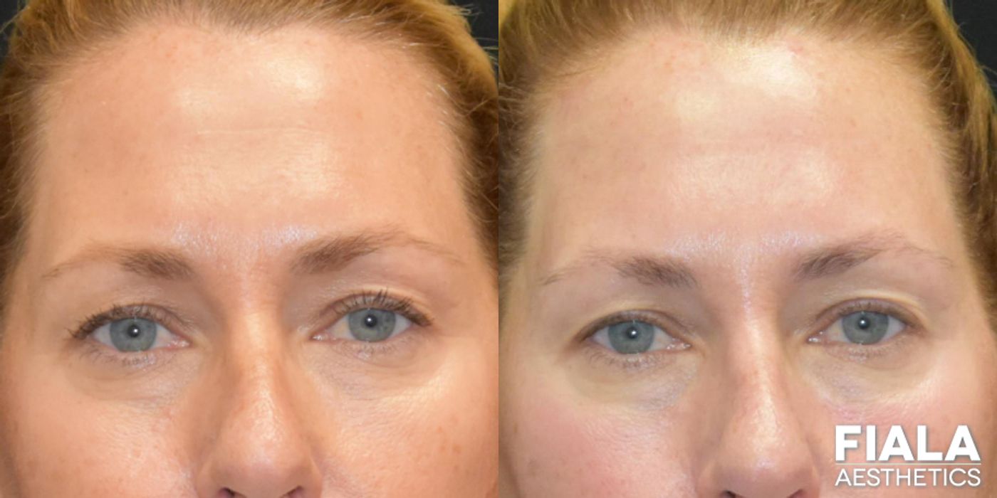 Before and after BOTOX Cosmetic case 13914 - Angle 2
