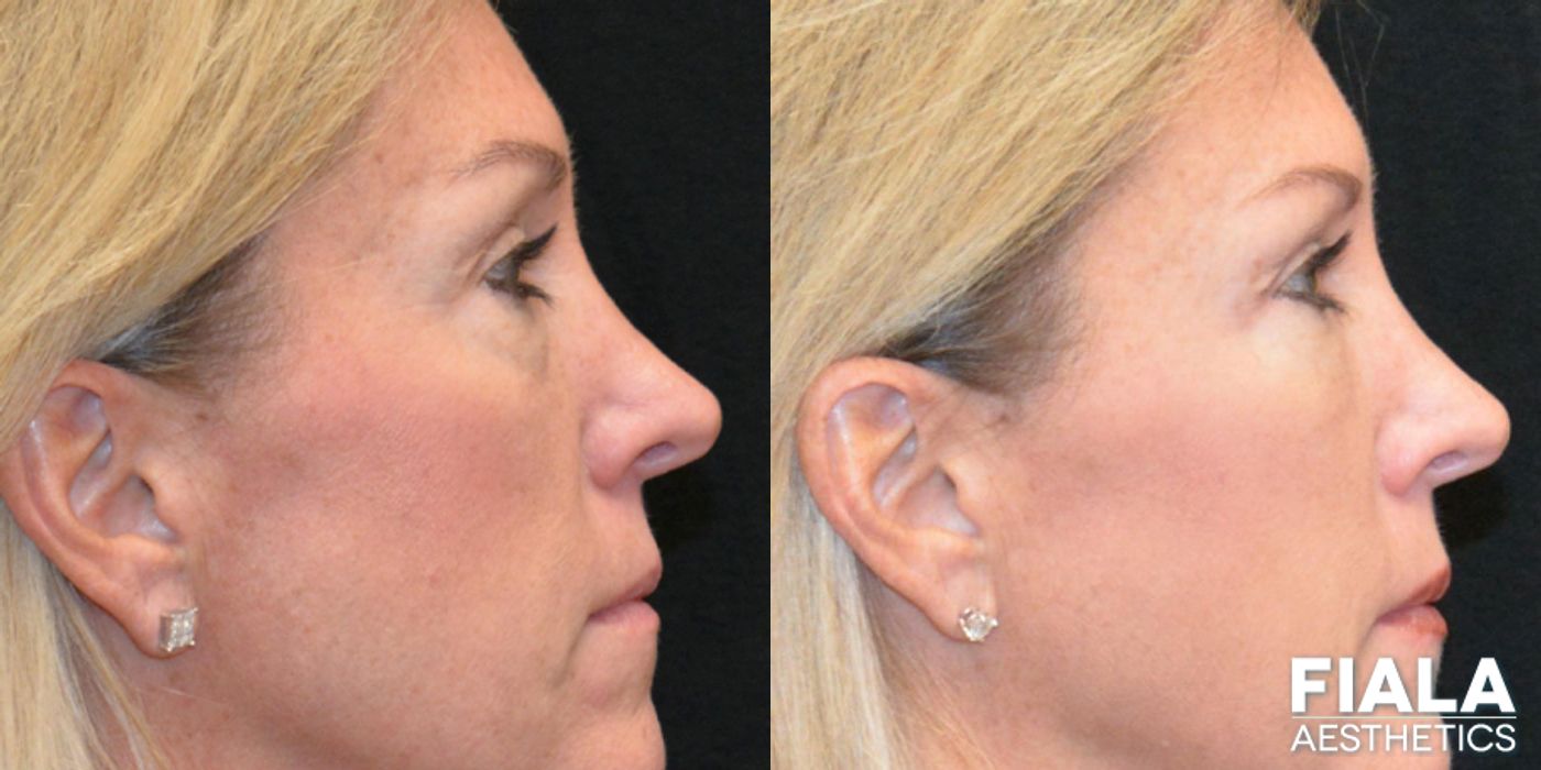 Before and after Dermal Fillers case 13916 - Angle 6