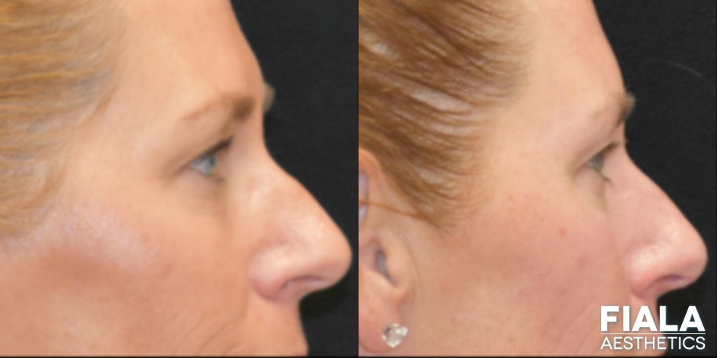 Before and after BOTOX Cosmetic case 13914 - Angle 6
