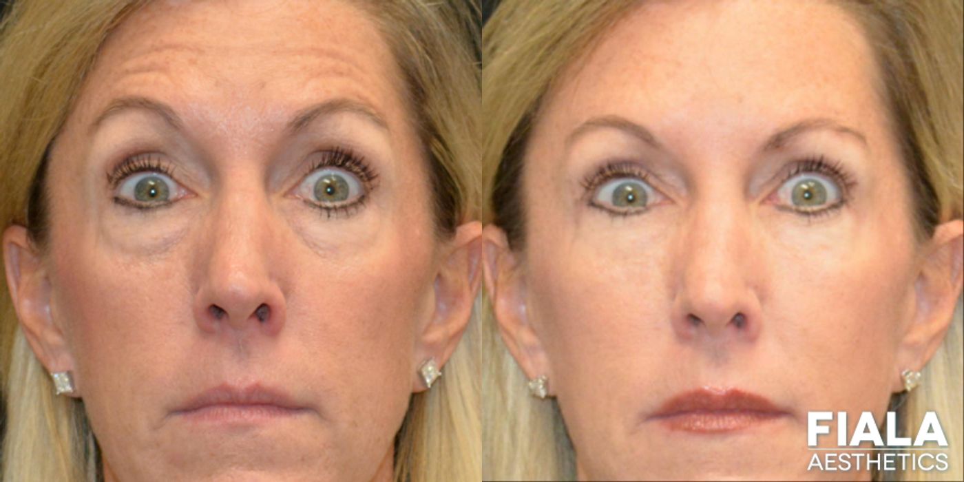 Before and after Dermal Fillers case 13916 - Angle 3