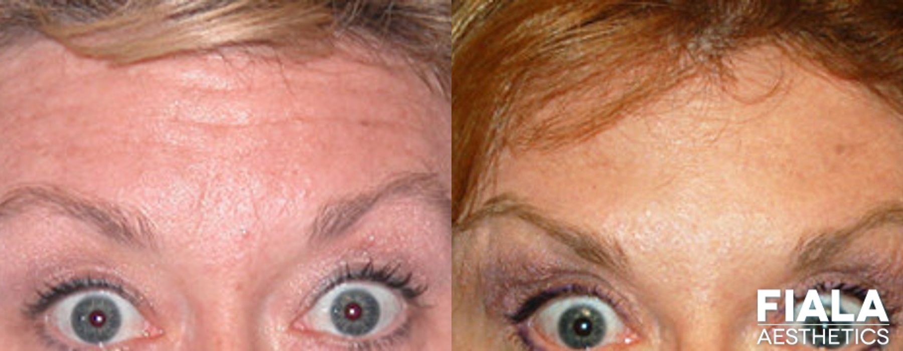 BOTOX Cosmetic - Case 9316