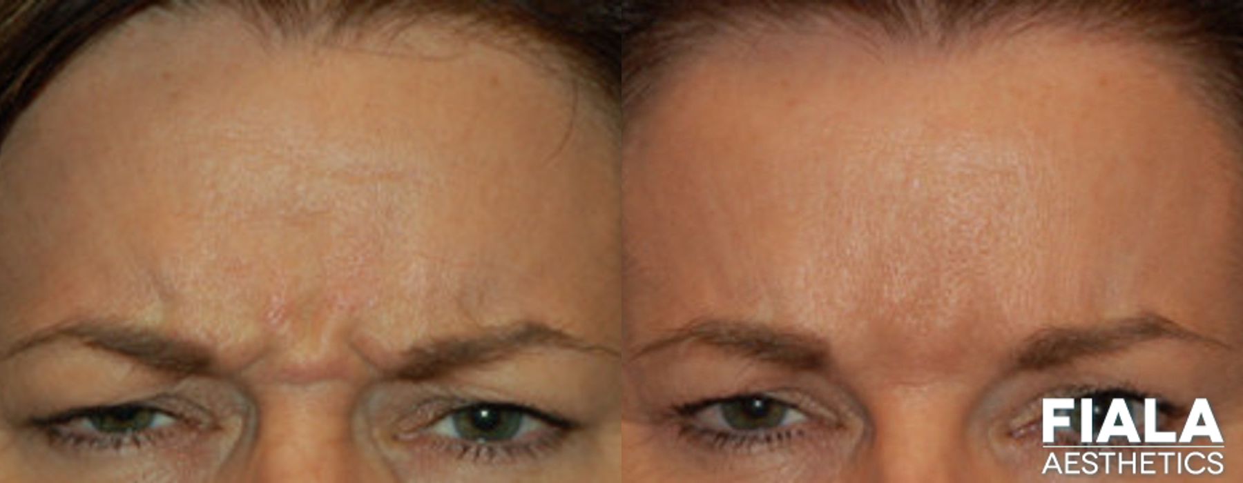 BOTOX Cosmetic - Case 9314