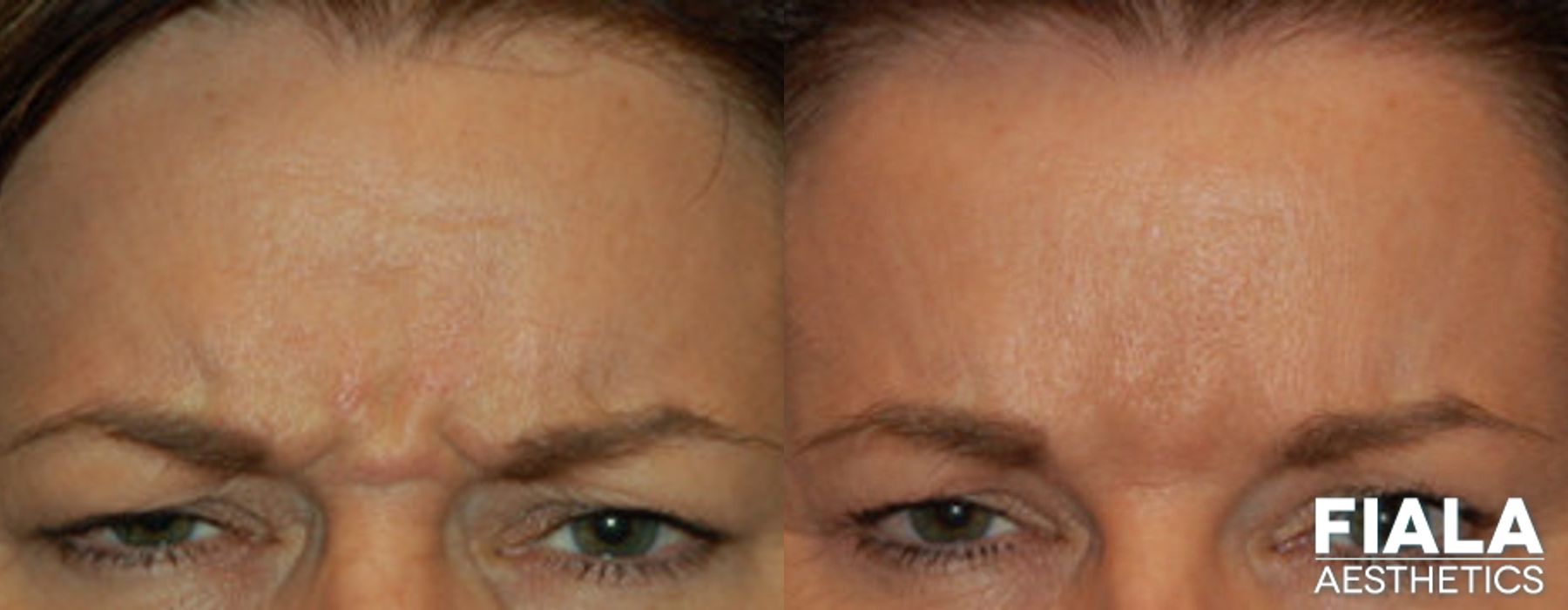 Before and after BOTOX Cosmetic case 13911