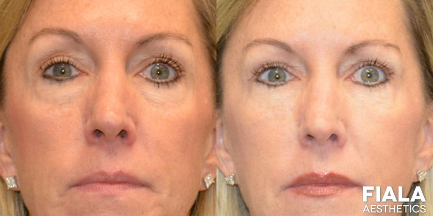 BOTOX Cosmetic - Thumbnail 2