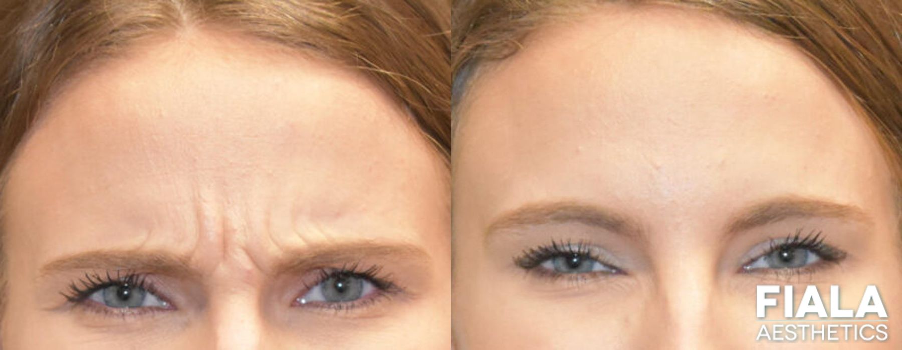 Botox results showing softened glabellar lines and forehead wrinkles with smoother, refreshed appearance by Dr. Fiala in Orlando - Angle 2