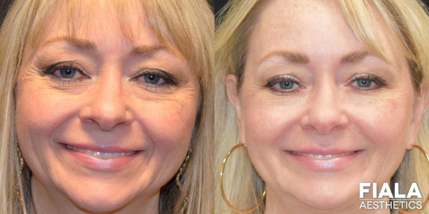 Before and after BOTOX Cosmetic case 13944