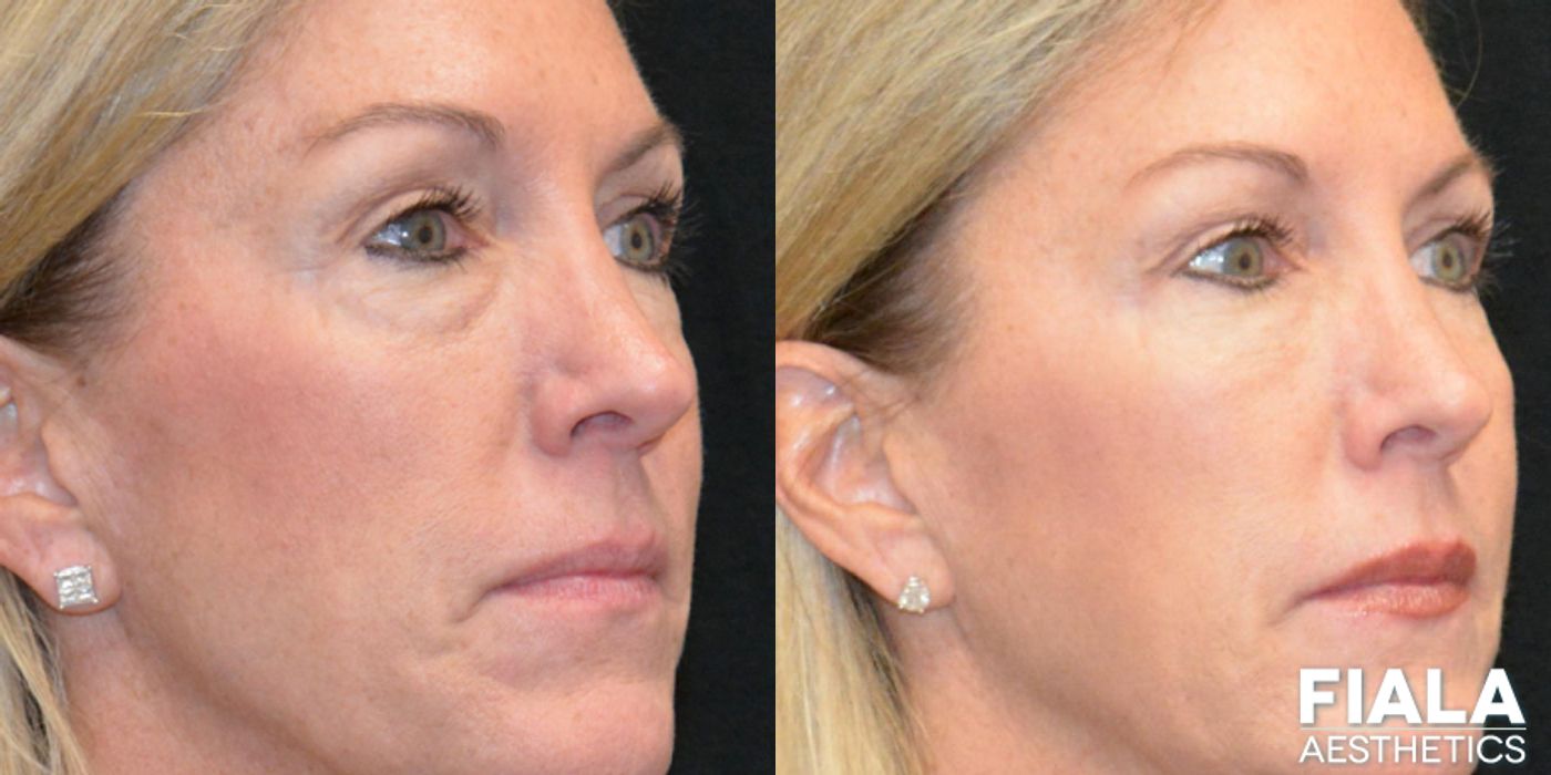 BOTOX Cosmetic - Thumbnail 5