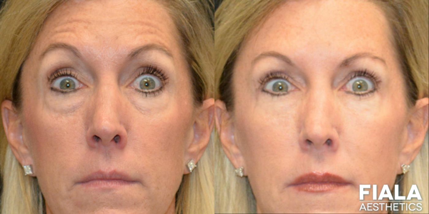 BOTOX Cosmetic - Thumbnail 3