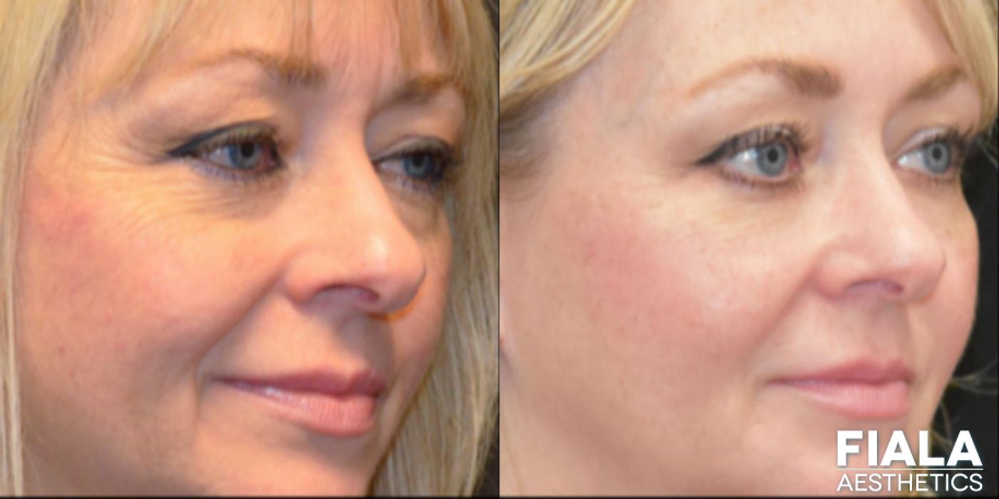 BOTOX Cosmetic - Thumbnail 3