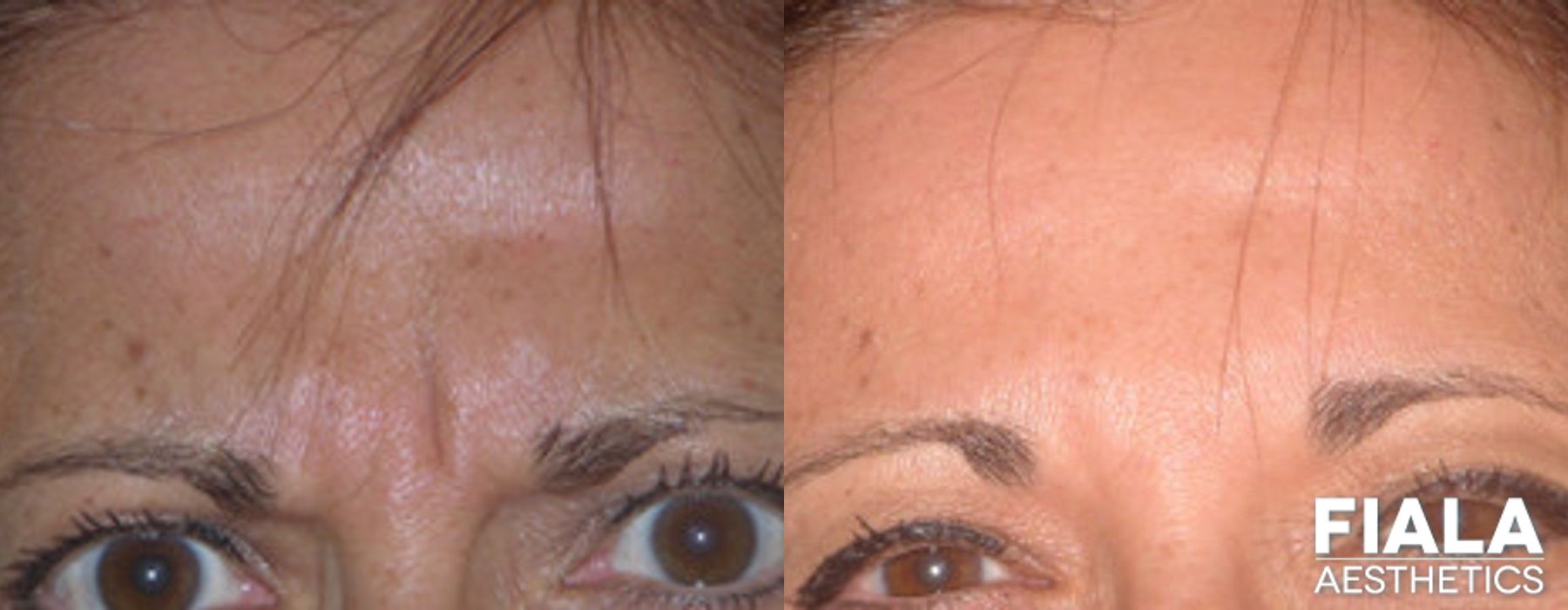 Before and after BOTOX Cosmetic case 13909