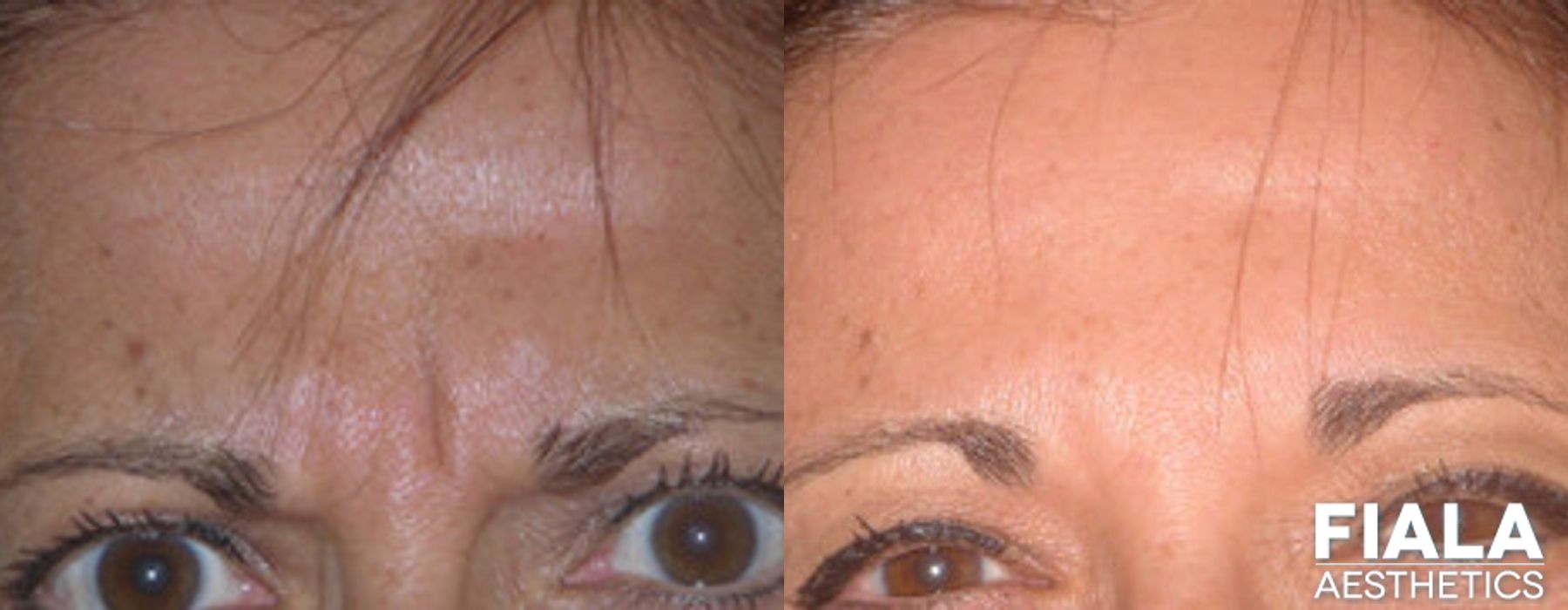 BOTOX Cosmetic - Case 9313