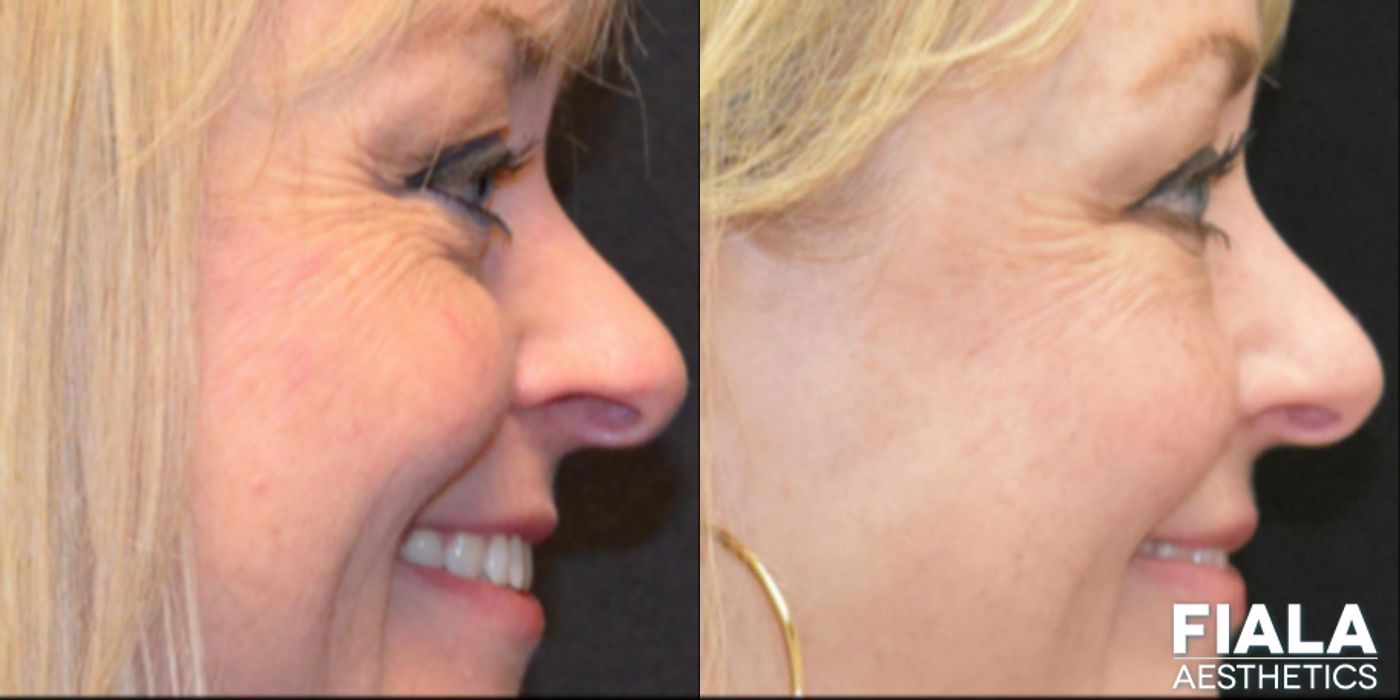 BOTOX Cosmetic - Thumbnail 4