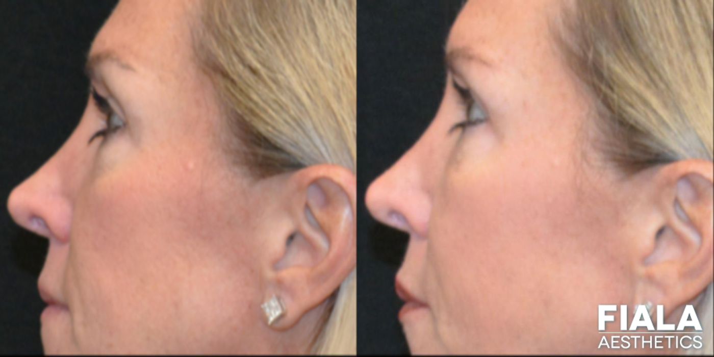 Before and after Dermal Fillers case 13916 - Angle 8