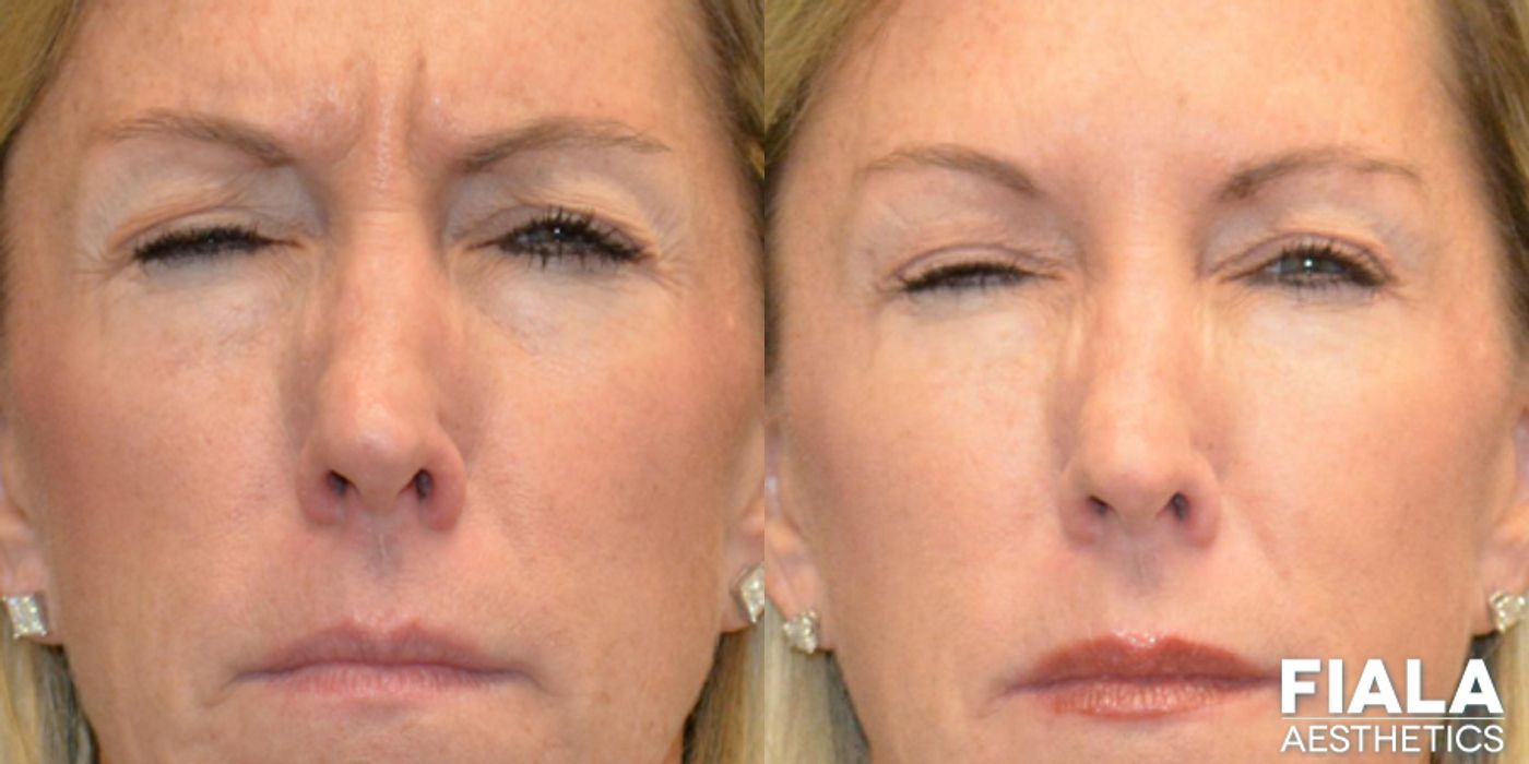 BOTOX Cosmetic - Case 9318