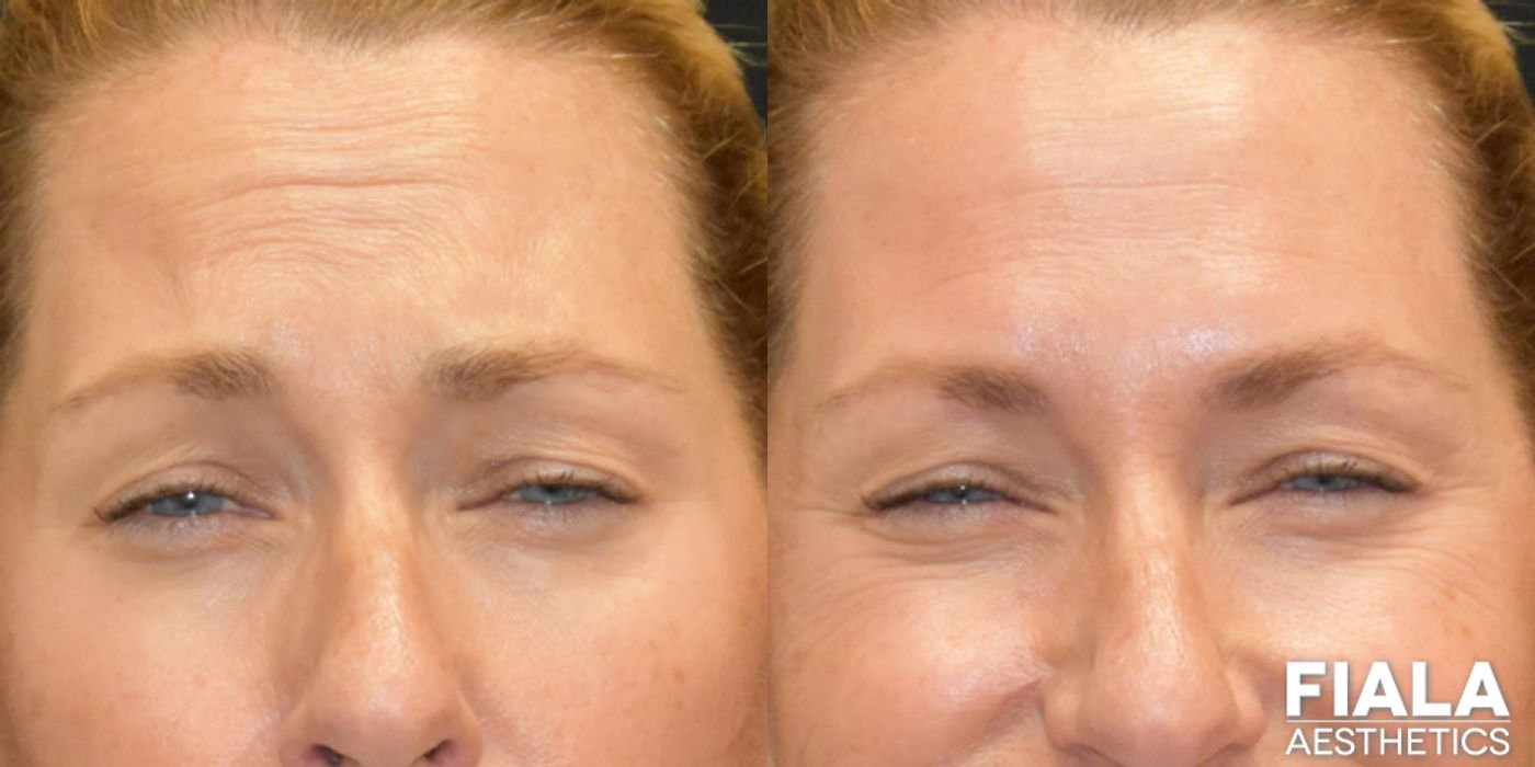 BOTOX Cosmetic - Thumbnail 3