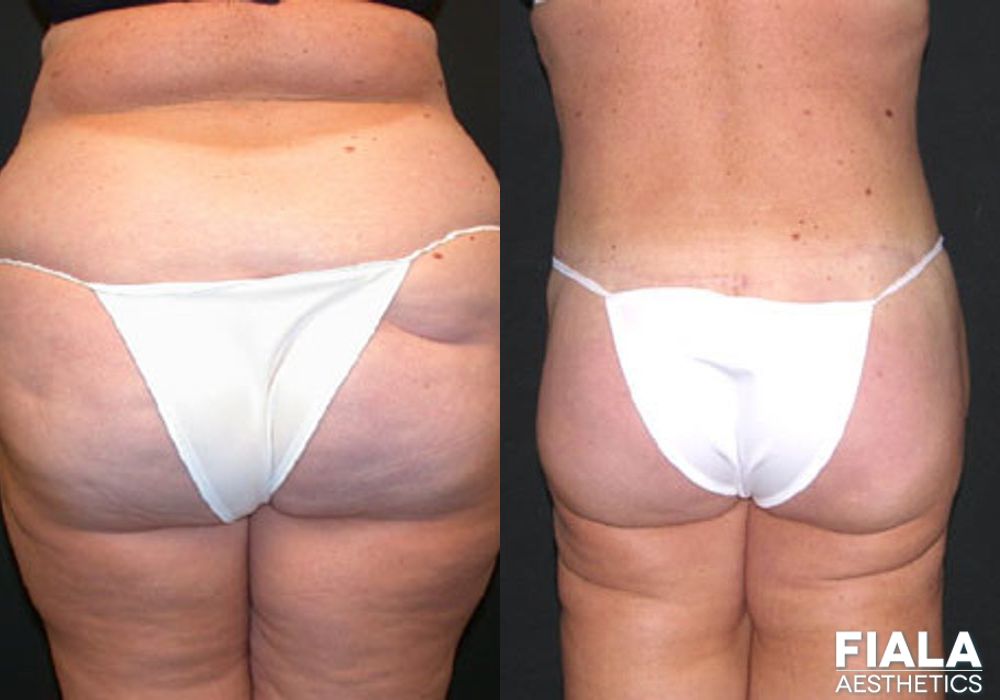 Body Lift - Case 8871