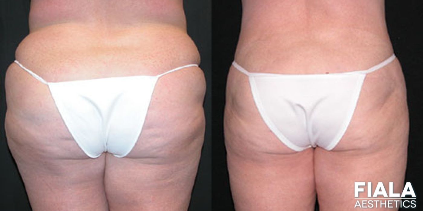 Before and after procedure result