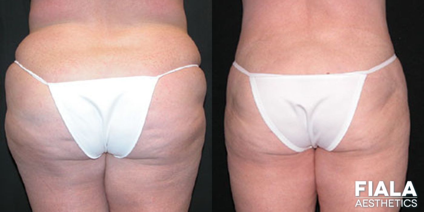 Before and after Tummy Tuck case 13794