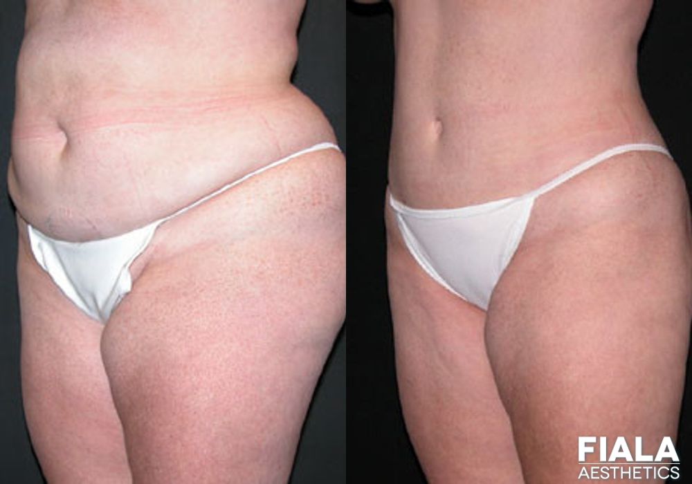 Body Lift - Thumbnail 2