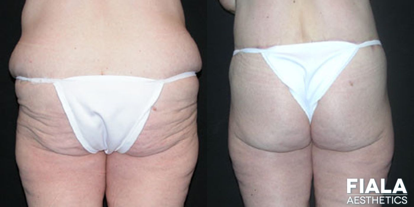 Body Lift - Case 9053