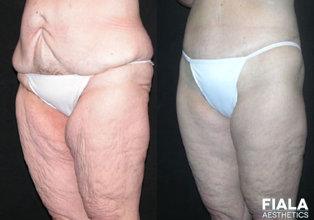 Body Lift - Thumbnail 2