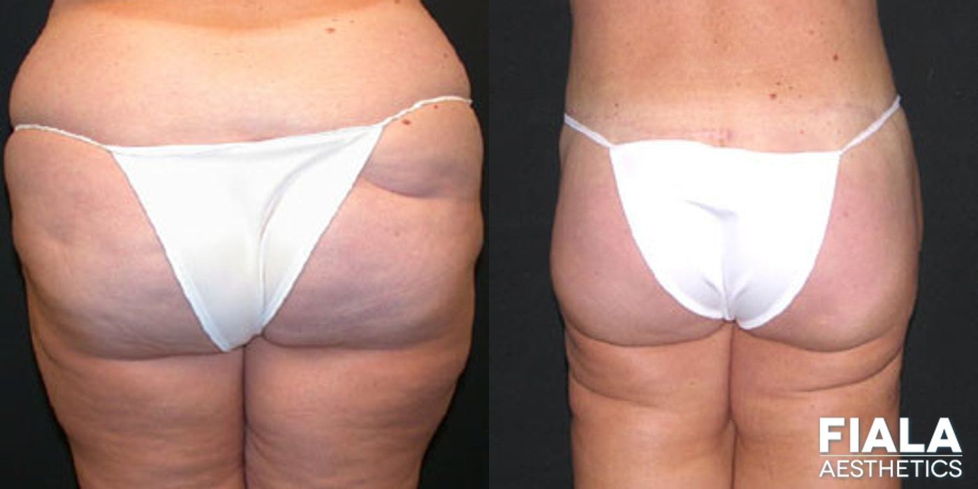 Before and after Body Lift case 13795