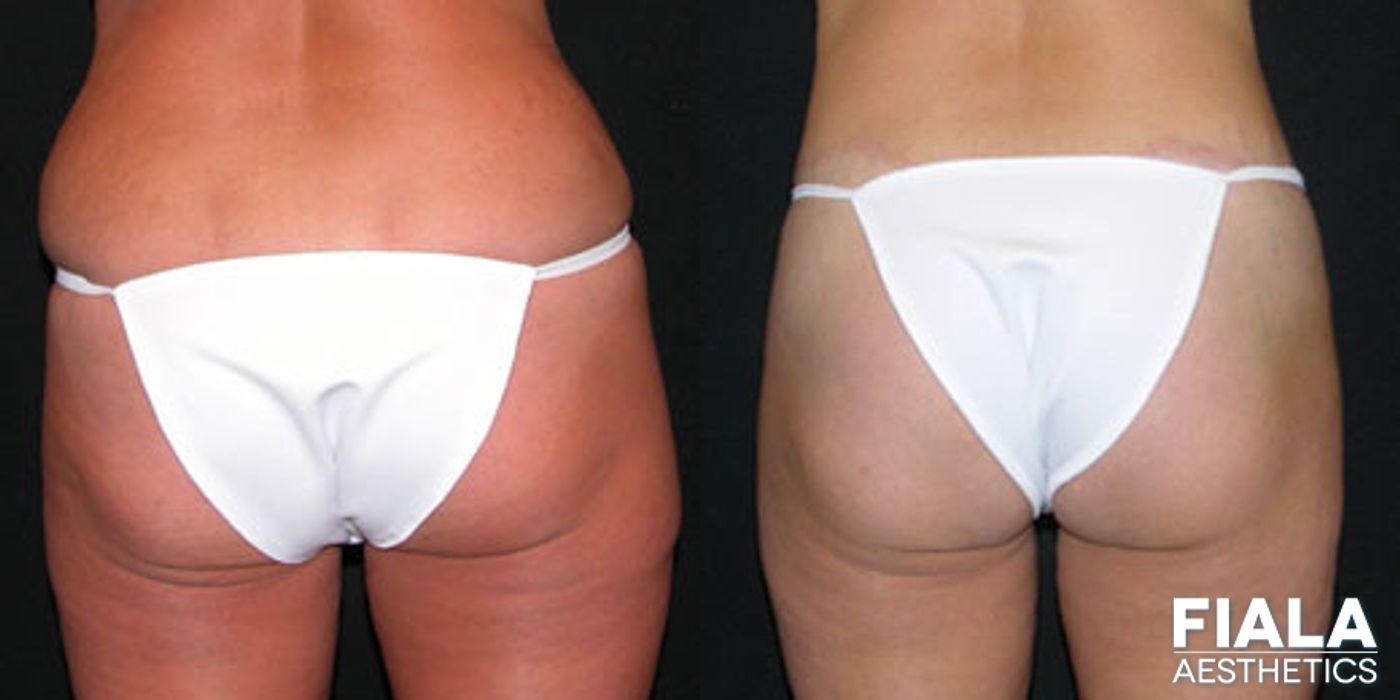 Before and after Body Lift case 13793 - Angle 2