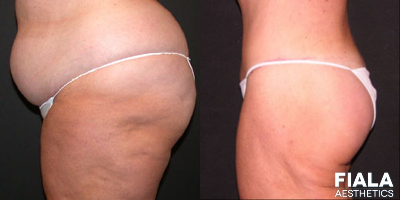 Body Lift - Thumbnail 2