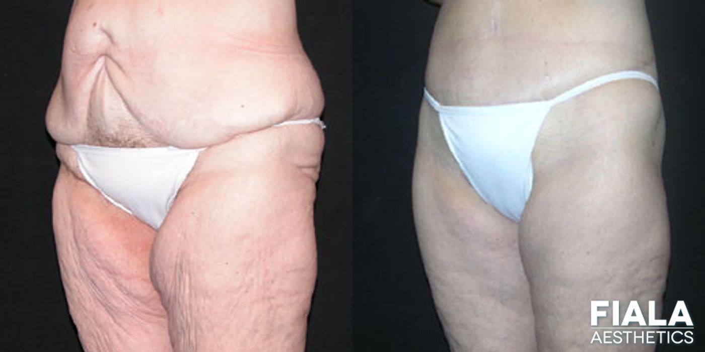 Before and after Body Lift case 13796 - Angle 2