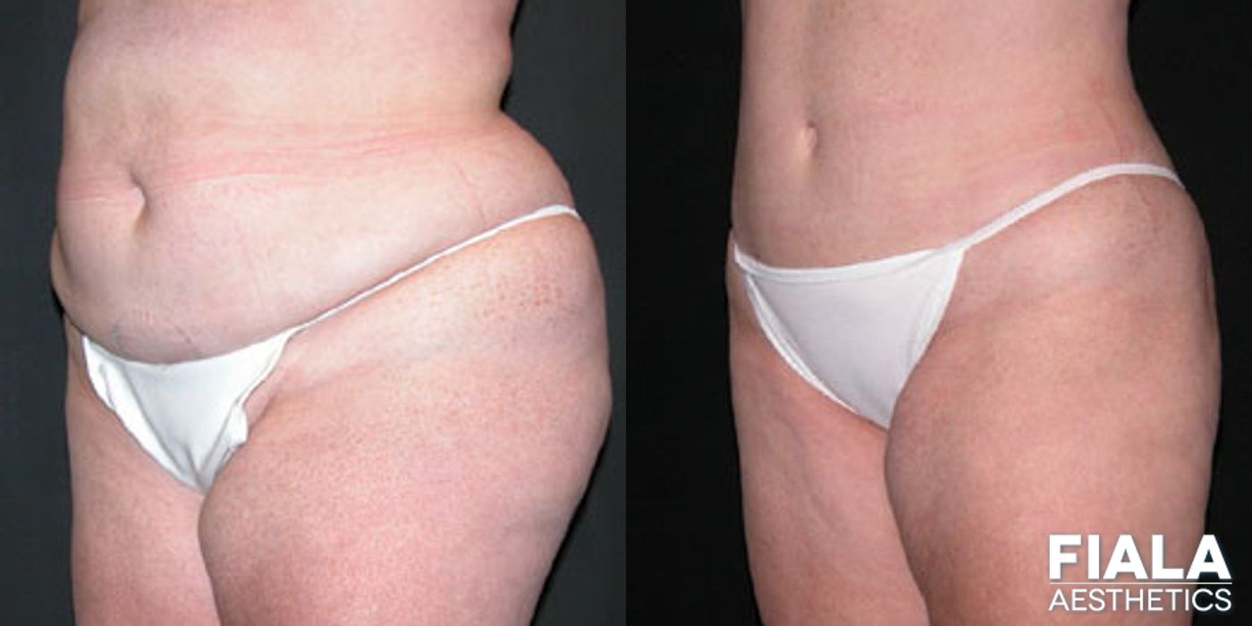 Before and after Tummy Tuck case 13794 - Angle 2