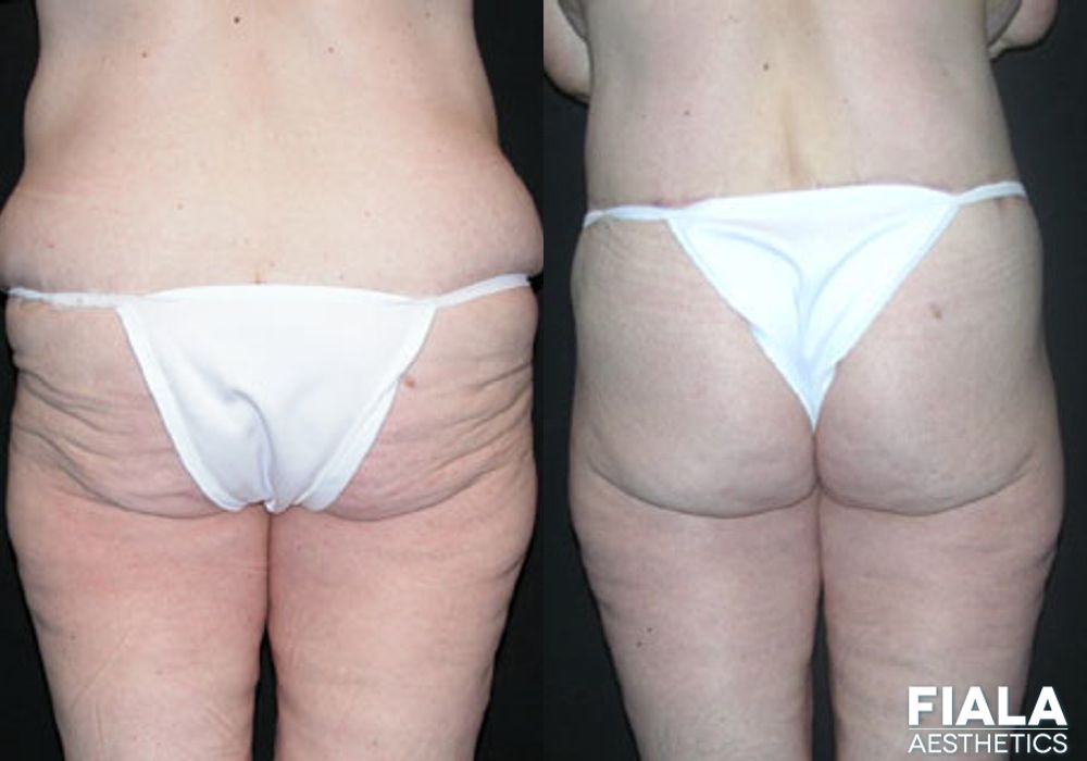 Body Lift - Case 8872