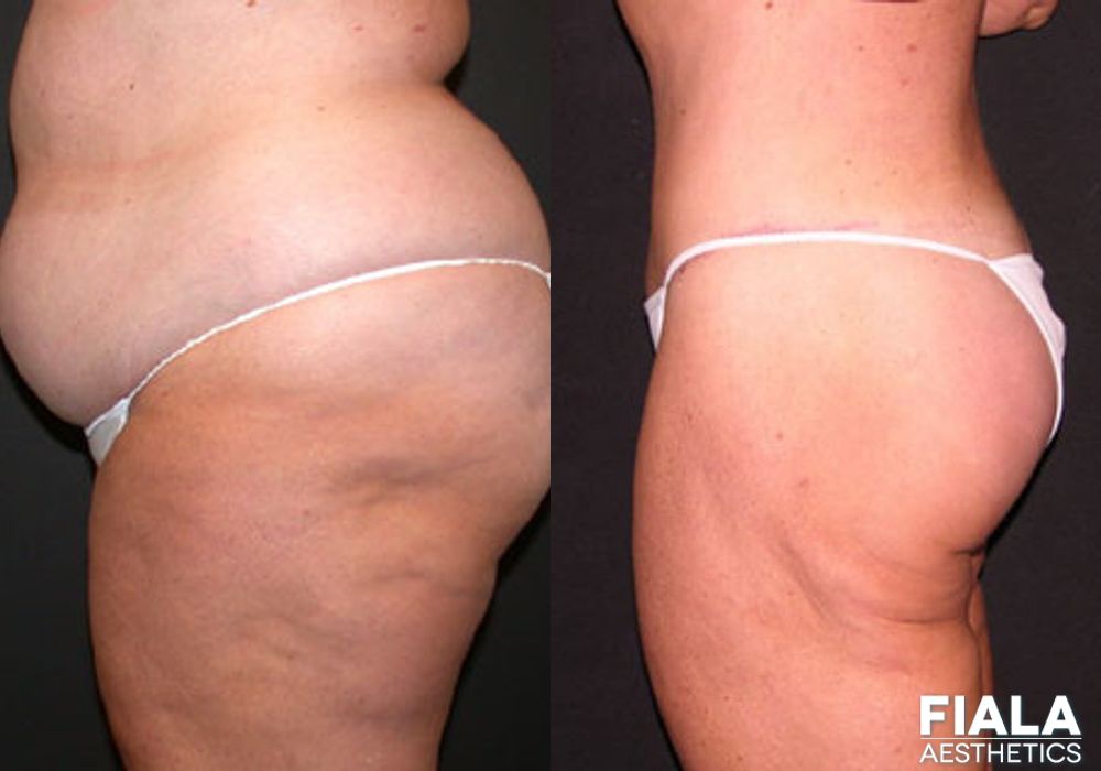 Body Lift - Thumbnail 2