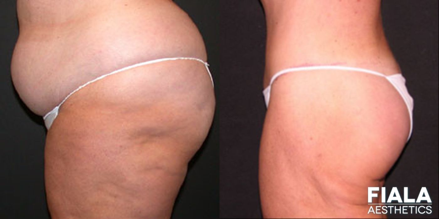 Before and after Body Lift case 13795 - Angle 2